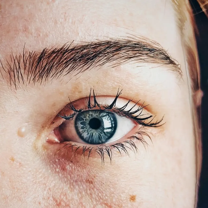 hyperpigmentation of the skin